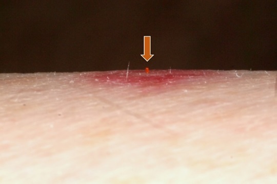 : Chiggers are external parasites only; they do not burrow into your skin and live there