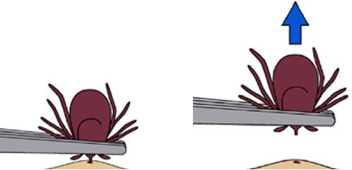Proper Tick Removal Proper Tick Removal