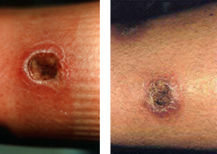 Bacterial Infection vs Brown Recluse Bite Bacterial Infection vs Brown Recluse Bite