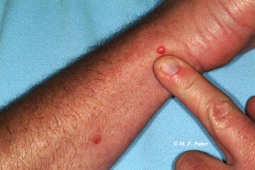 ‘Bug bites’ are difficult to diagnose, even by physicians. 