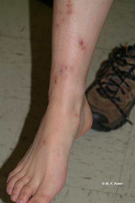 Fleas generally bite low on the leg, whereas bed bugs attack any exposed skin.