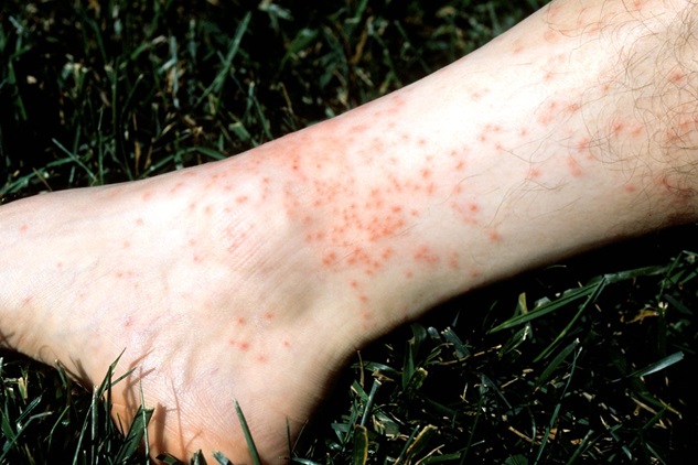 The ankles, knees, groins, waists, and armpits are all chigger bit hotspots. People can be bitten by a few to many chiggers and react in different ways.