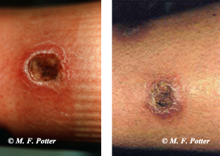 Many medical conditions are mistaken for brown recluse bites. The wound on the left is from a recluse spider, the one on the right from a bacterial infection.