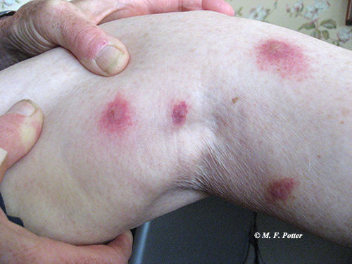 Chigger bites produce hardened welts that itch intensely.