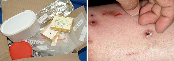 Delusions of parasitosis patients often submit numerous samples for identification. Self-inflicted scratches and scarring may also be evident. Delusions of parasitosis patients often submit numerous samples for identification. Self-inflicted scratches and scarring may also be evident.