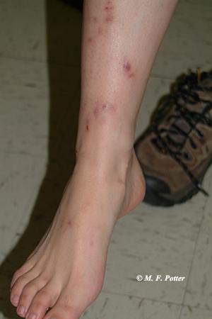 Fleas generally bite low on the leg, whereas bed bugs attack any exposed skin. Fleas generally bite low on the leg, whereas bed bugs attack any exposed skin.